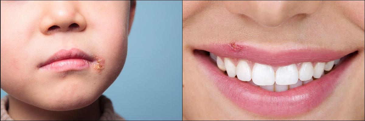 how to prevent cold sores